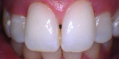 After image