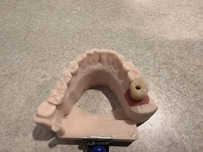 dental implant crafted at Kanellis Family Dentisry