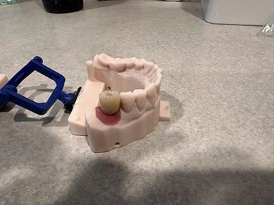dental implant created by Dr. Kanellis in Sparks, NV