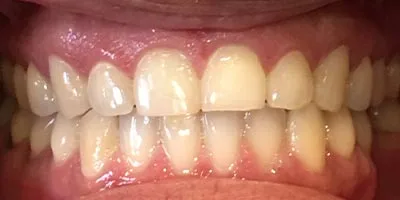 After image