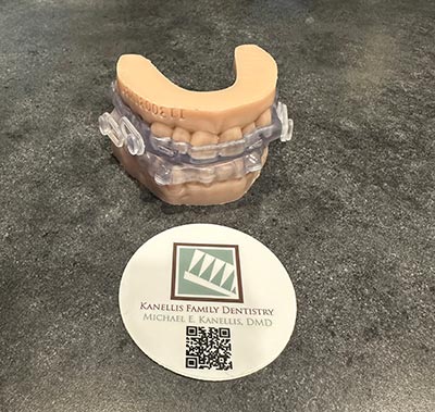 Custom Sleep Apnea Appliance